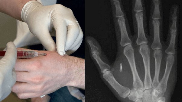 Microchip Implants